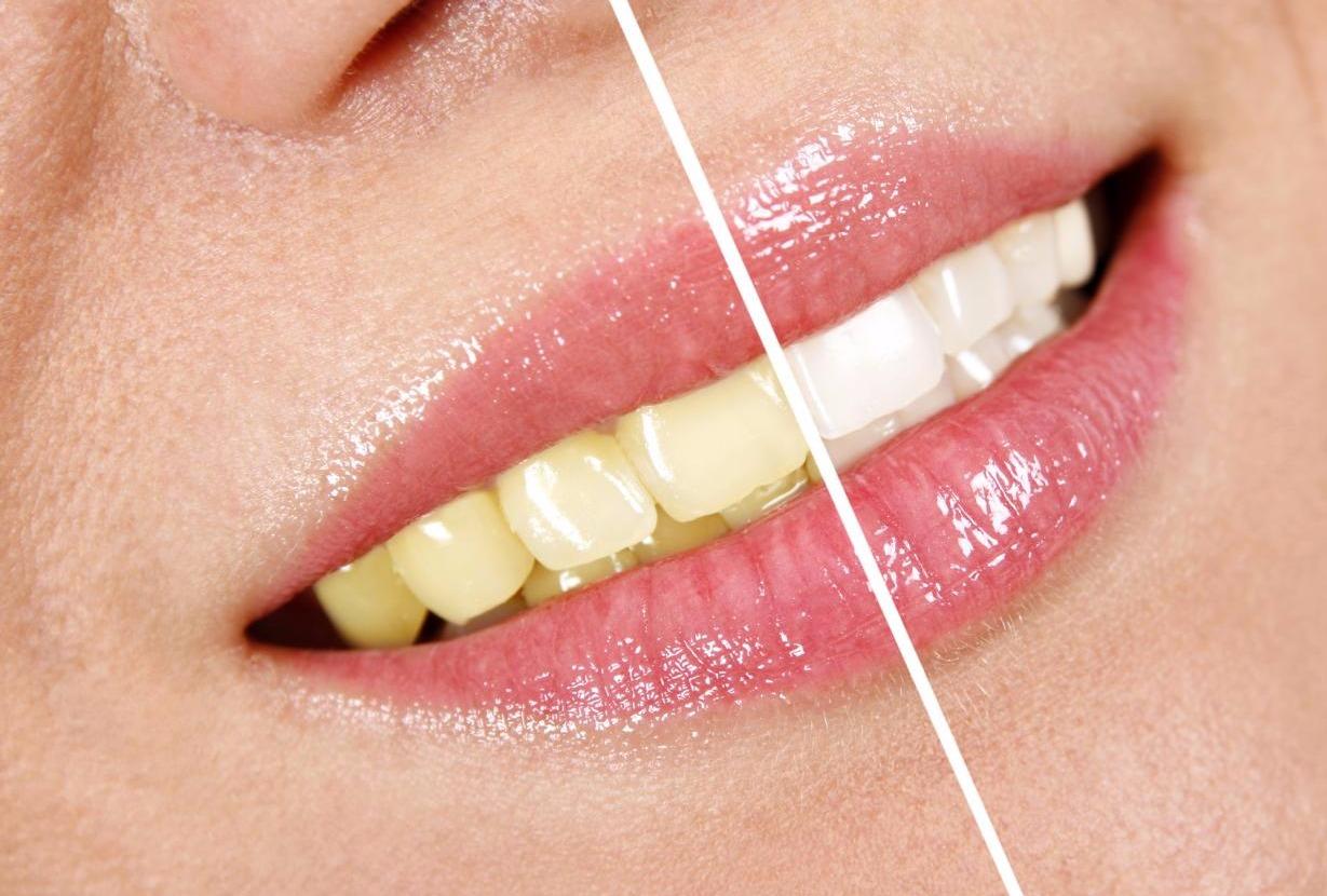 Dental cleaning Terrebonne Lanaudiere North Shore